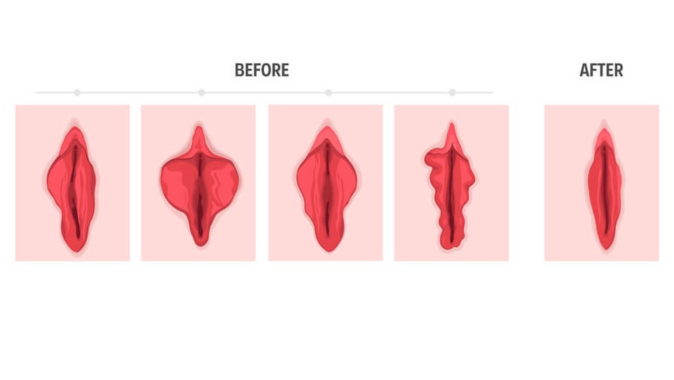 Labiaplasty Before and After